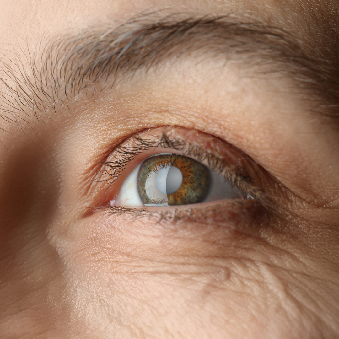 Close up image of a brown eye, showing a cloudy pupil, cataracts. Dry Age-Related Macular Degeneration.